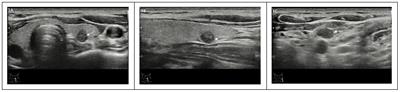 Construction and validation of a diagnostic model for high-risk papillary thyroid microcarcinoma